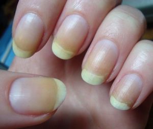 unhas amarelas