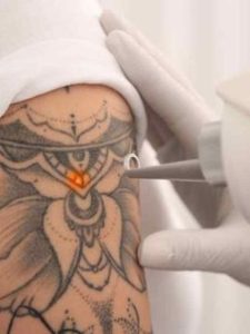 remoção tattoo