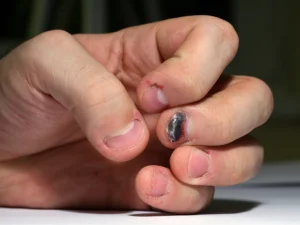 melanoma-de-unhas-1024x768