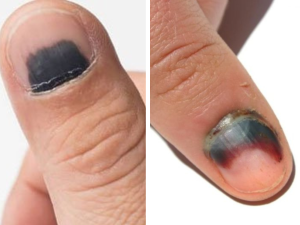 Unhas-roxas-perto-da-raiz