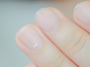 Manchas brancas nas unhas